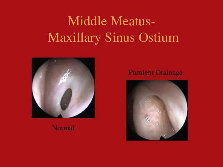 Middle Meatus- Maxillary Sinus Ostium Purulent Drainage Normal