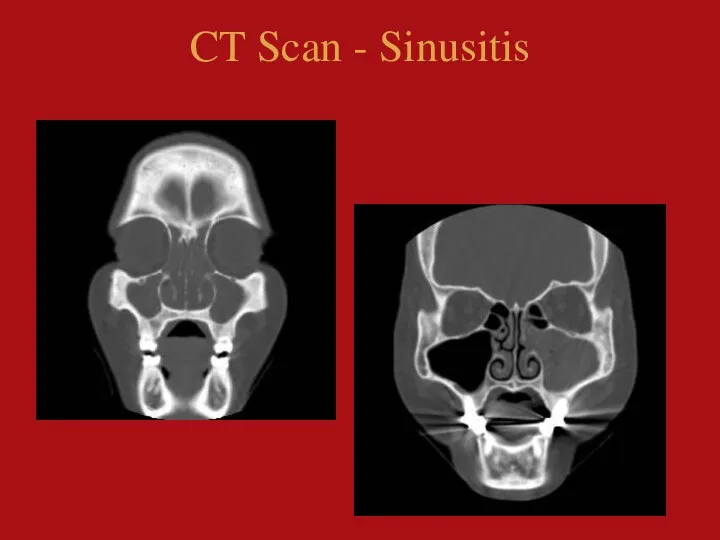 CT Scan - Sinusitis