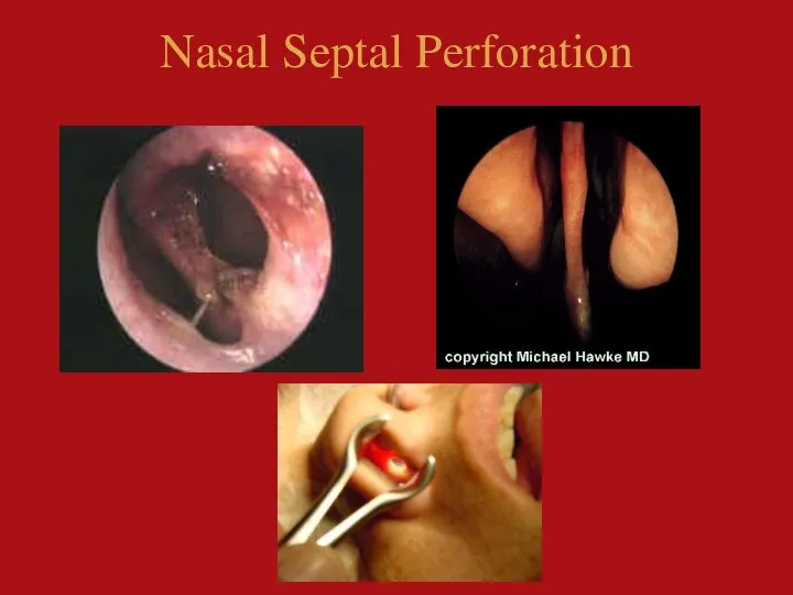 Nasal Septal Perforation