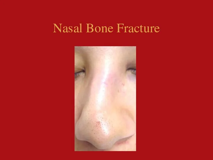 Nasal Bone Fracture