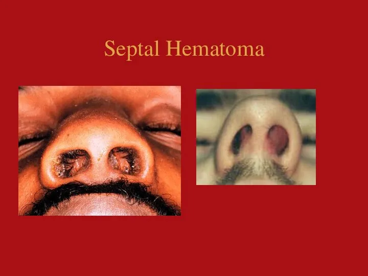 Septal Hematoma