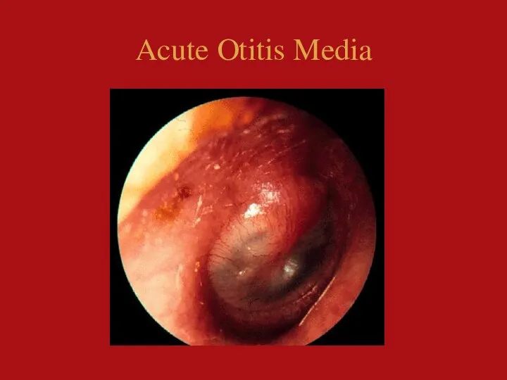 Acute Otitis Media