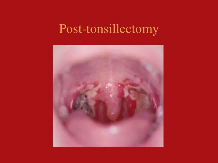 Post-tonsillectomy