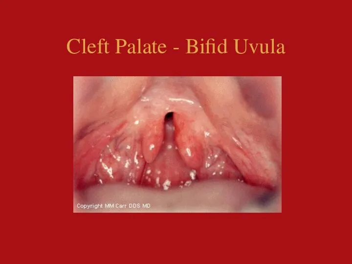 Cleft Palate - Bifid Uvula