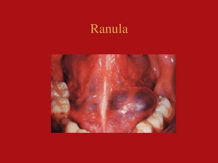 Ranula