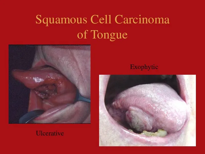 Squamous Cell Carcinoma of Tongue Exophytic Ulcerative