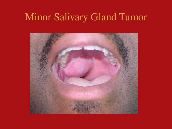 Minor Salivary Gland Tumor