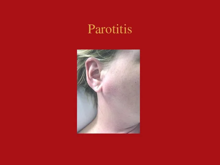 Parotitis