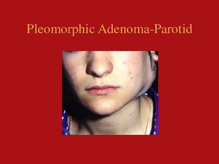 Pleomorphic Adenoma-Parotid