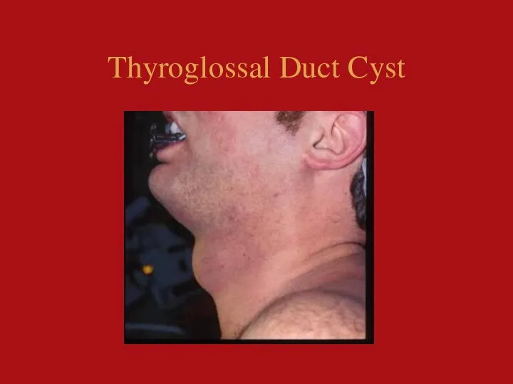 Thyroglossal Duct Cyst