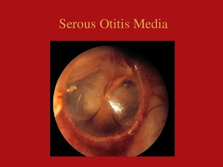 Serous Otitis Media