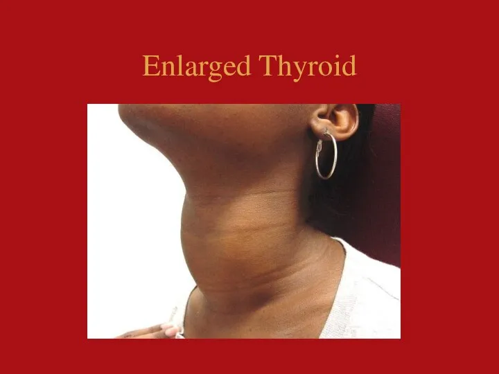 Enlarged Thyroid