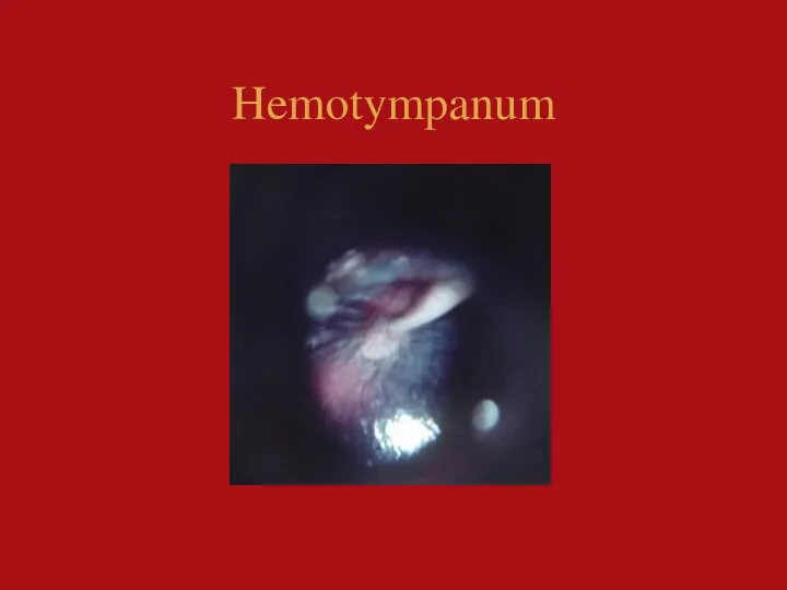 Hemotympanum