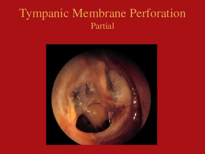 Tympanic Membrane Perforation Partial