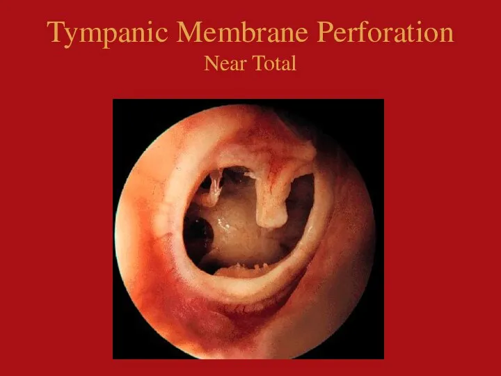 Tympanic Membrane Perforation Near Total