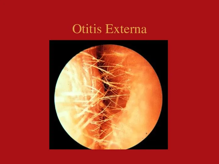 Otitis Externa