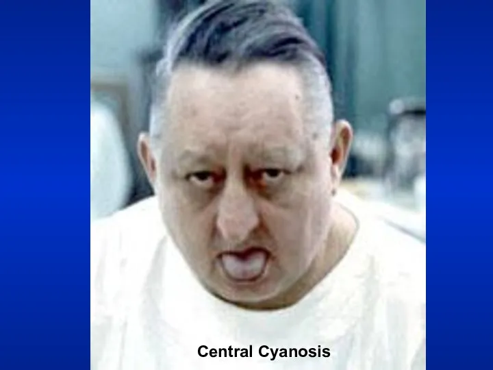 Central Cyanosis