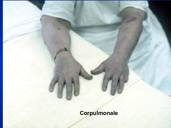 Corpulmonale