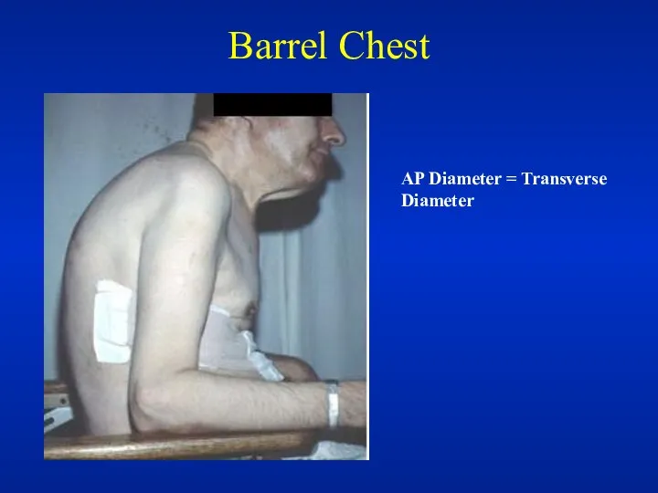 Barrel Chest AP Diameter = Transverse Diameter