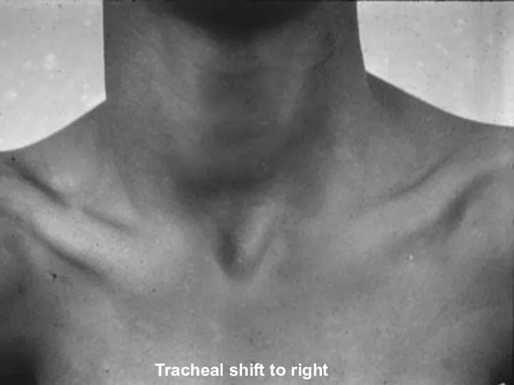 Tracheal shift to right