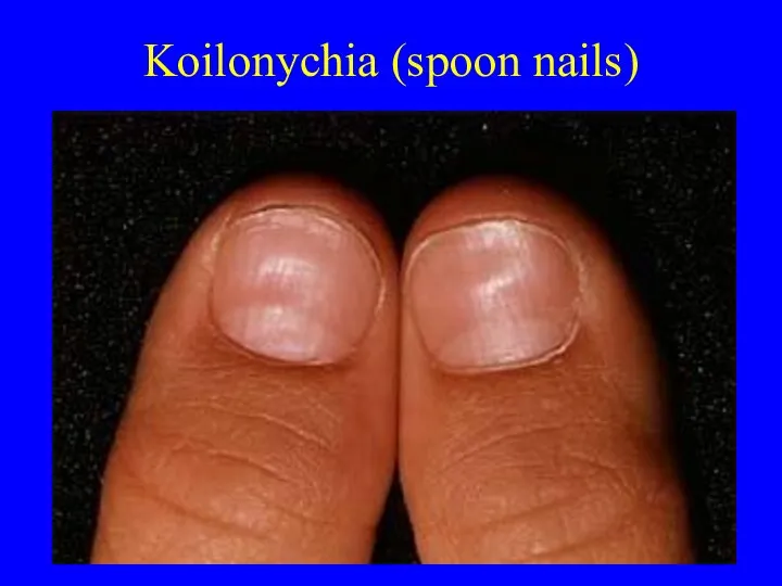 Koilonychia (spoon nails)