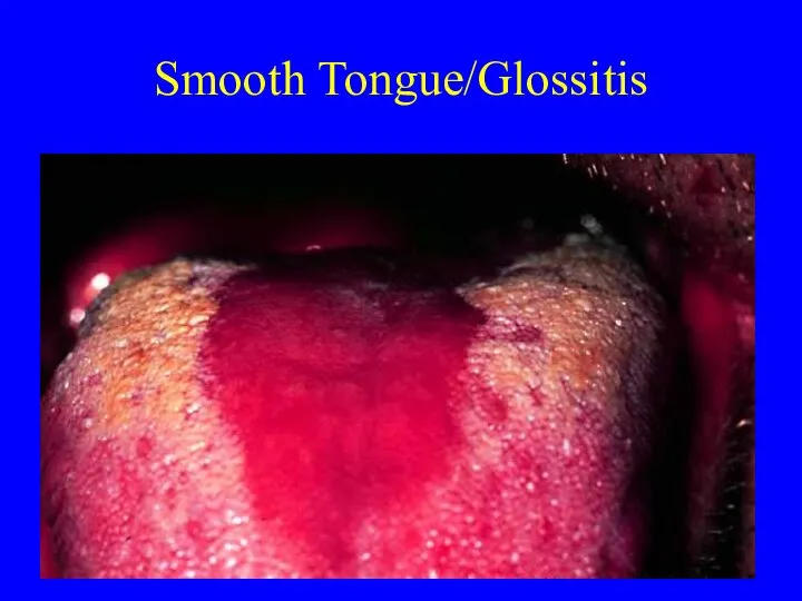 Smooth Tongue/Glossitis