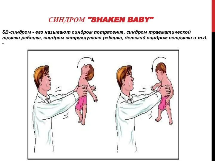 СИНДРОМ "SHAKEN BABY" SВ-синдром - его называют синдром потрясения, синдром травматической