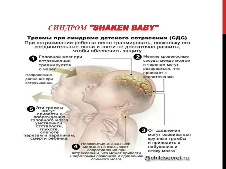 СИНДРОМ "SHAKEN BABY"