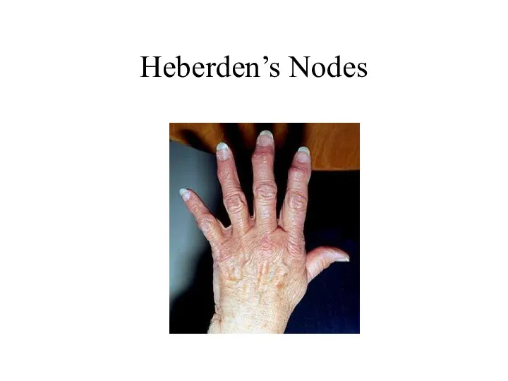 Heberden’s Nodes