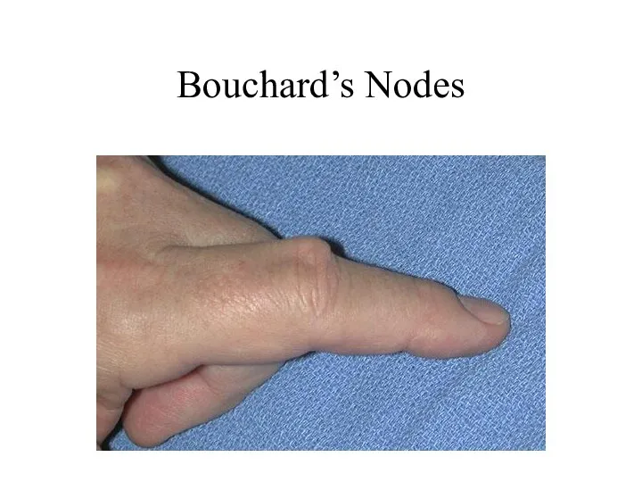 Bouchard’s Nodes