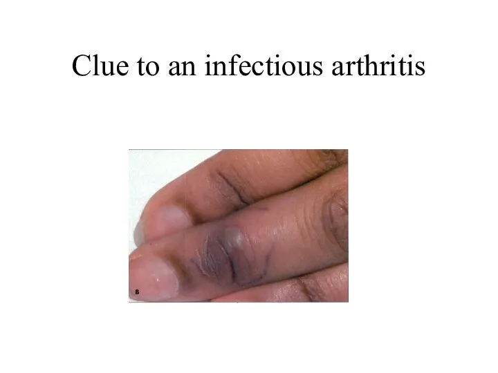 Clue to an infectious arthritis