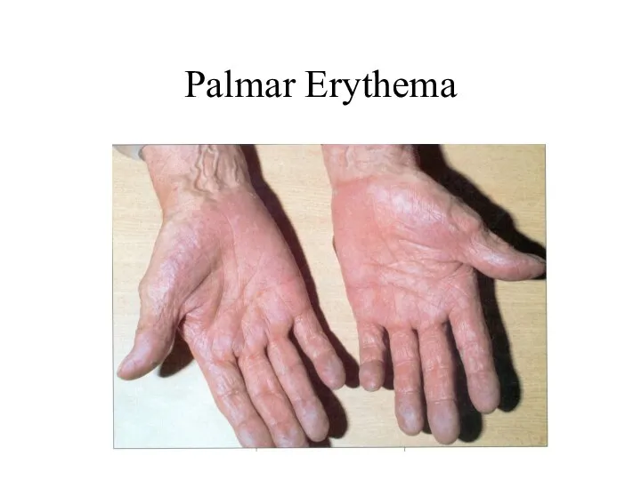 Palmar Erythema