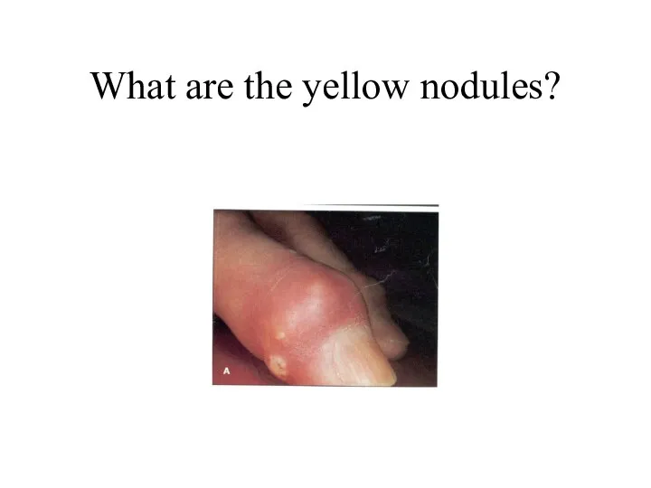 What are the yellow nodules?