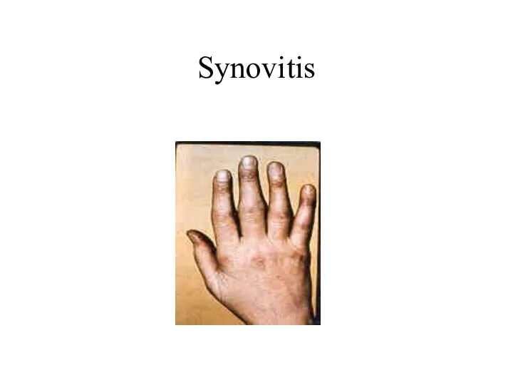 Synovitis