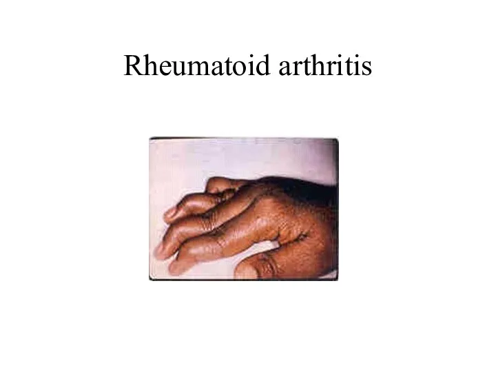 Rheumatoid arthritis