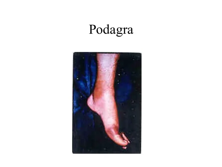 Podagra