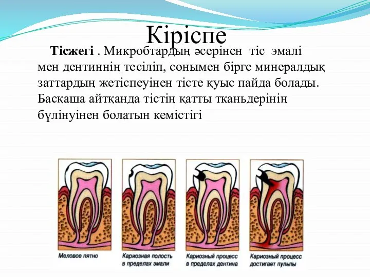 Кіріспе Тісжегі . Микробтардың әсерінен тіс эмалі мен дентиннің тесіліп, сонымен