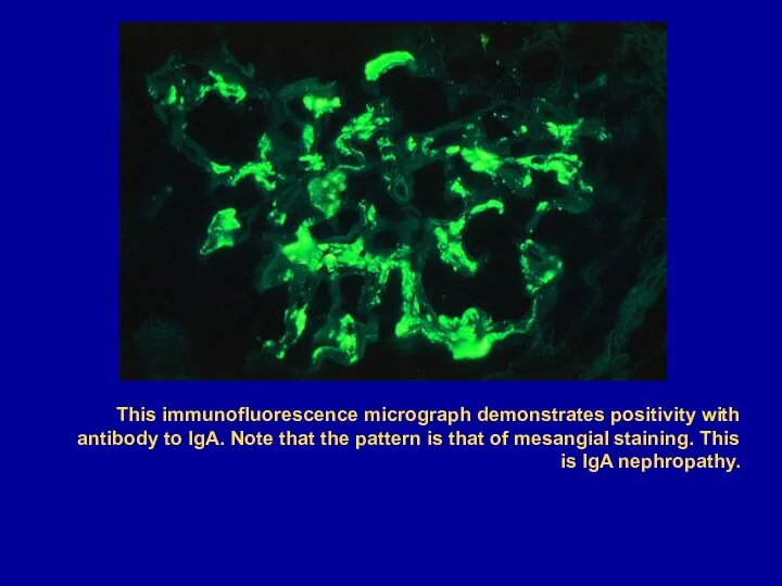 This immunofluorescence micrograph demonstrates positivity with antibody to IgA. Note that