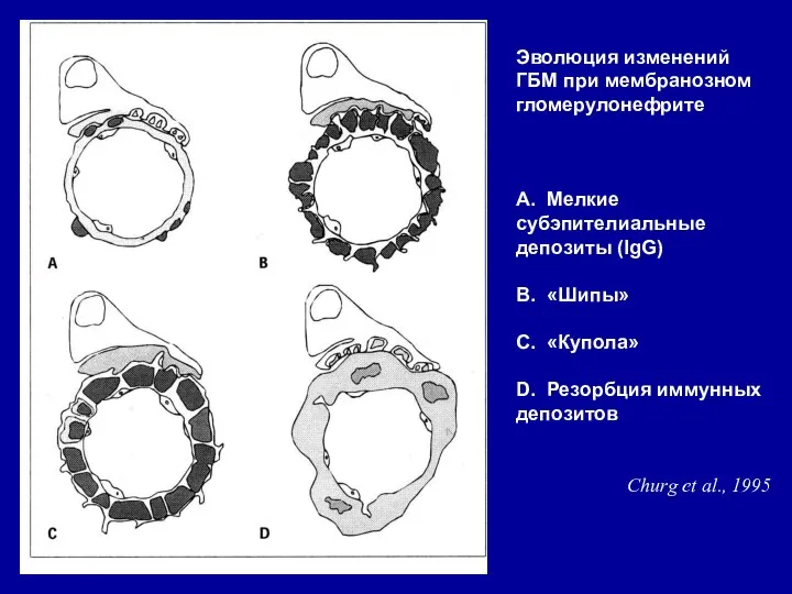 Эволюция изменений ГБМ при мембранозном гломерулонефрите А. Мелкие субэпителиальные депозиты (IgG)