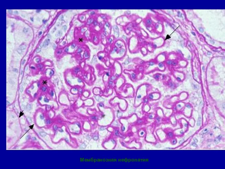 Мембранозная нефропатия