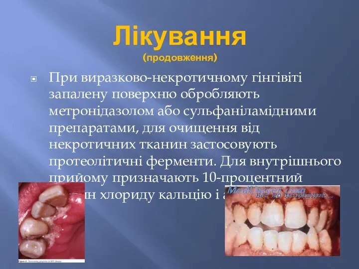 Лікування (продовження) При виразково-некротичному гінгівіті запалену поверхню обробляють метронідазолом або сульфаніламідними