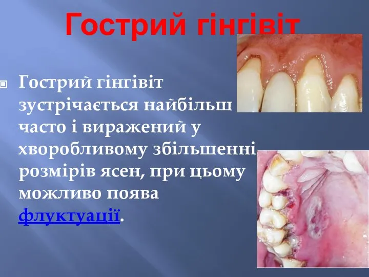 Гострий гінгівіт Гострий гінгівіт зустрічається найбільш часто і виражений у хворобливому