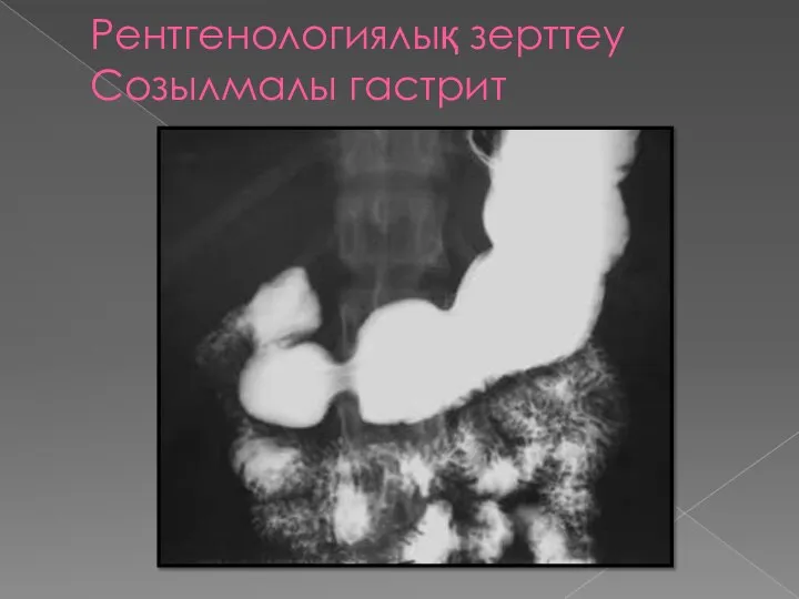 Рентгенологиялық зерттеу Созылмалы гастрит