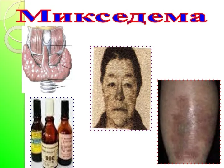 Микседема