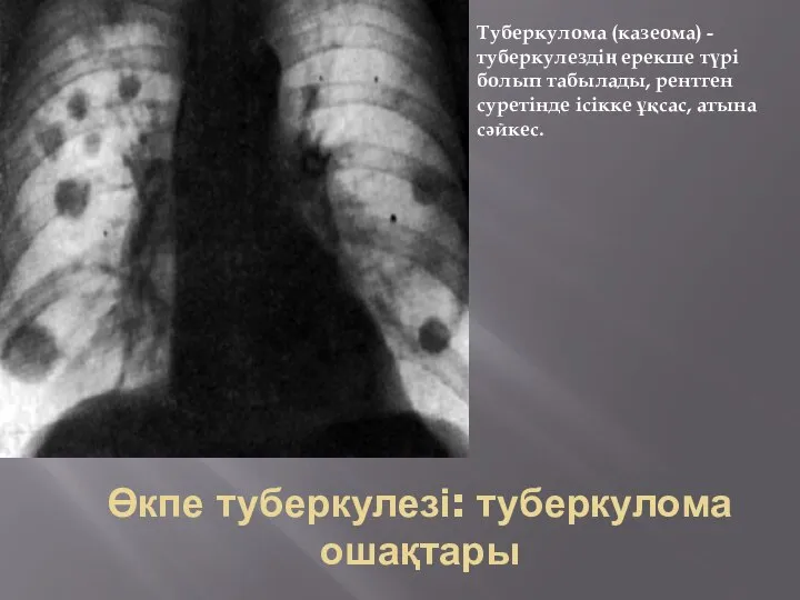 Өкпе туберкулезі: туберкулома ошақтары Туберкулома (казеома) -туберкулездің ерекше түрі болып табылады,