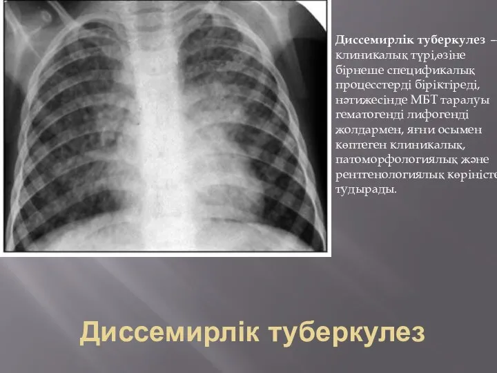 Диссемирлік туберкулез Диссемирлік туберкулез —клиникалық түрі,өзіне бірнеше спецификалық процесстерді біріктіреді, нәтижесінде