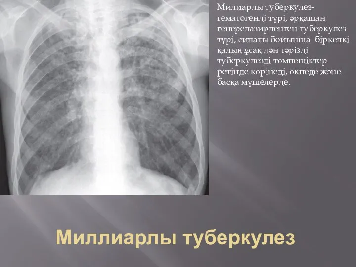 Миллиарлы туберкулез Милиарлы туберкулез- гематогенді түрі, әрқашан генерелазирленген туберкулез түрі, сипаты