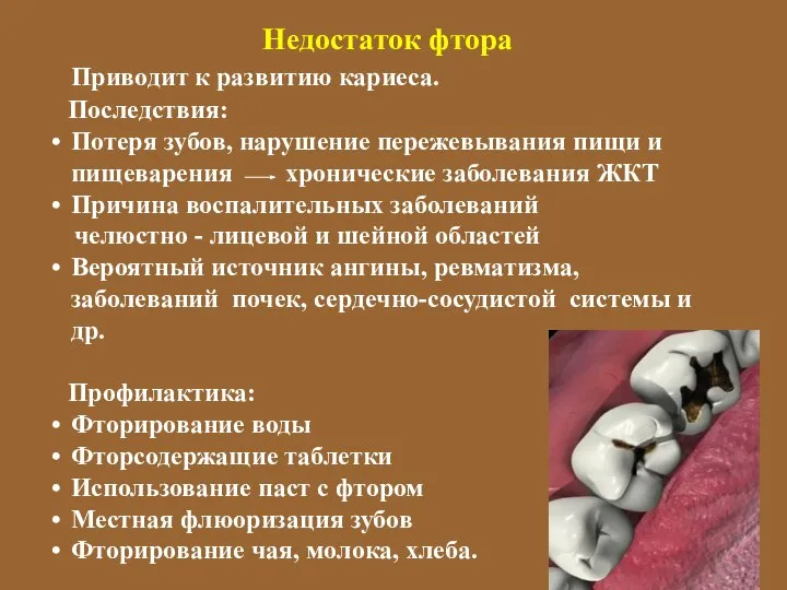 Недостаток фтора Приводит к развитию кариеса. Последствия: Потеря зубов, нарушение пережевывания