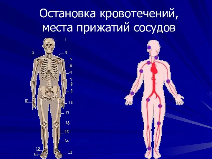 Остановка кровотечений, места прижатий сосудов