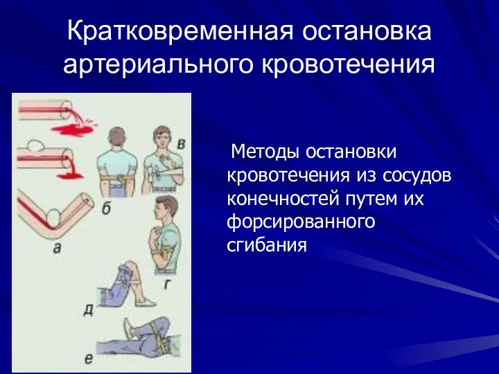 Кратковременная остановка артериального кровотечения Методы остановки кровотечения из сосудов конечностей путем их форсированного сгибания